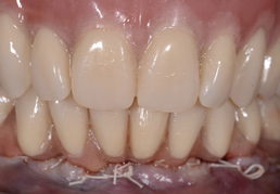 hybrid-dentures