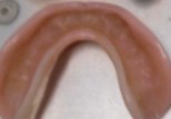 immediate-dentures