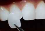 Veneers