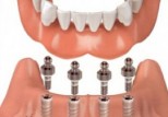 Implant supported denture