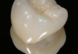 Dental Crown